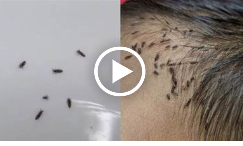 Esses bichinhos estavam vivendo na cabeça dessa criança, veja o vídeo ...